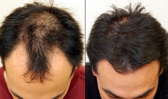 Best Artificial Hair Implantation In Pitampura Rohini Delhi | Biofibre Hair  Implant In Pitampura Rohini Delhi